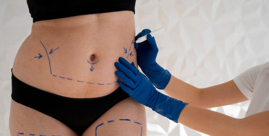 body-lifting-threads.jpg